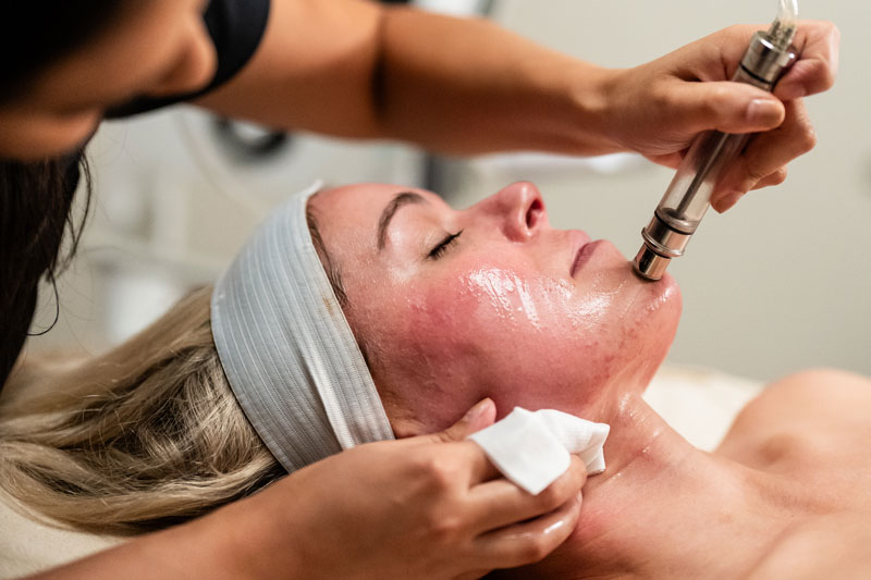 Microdermabrasion is performed by an esthetician in a facial spa in Flower Mound, Texas.